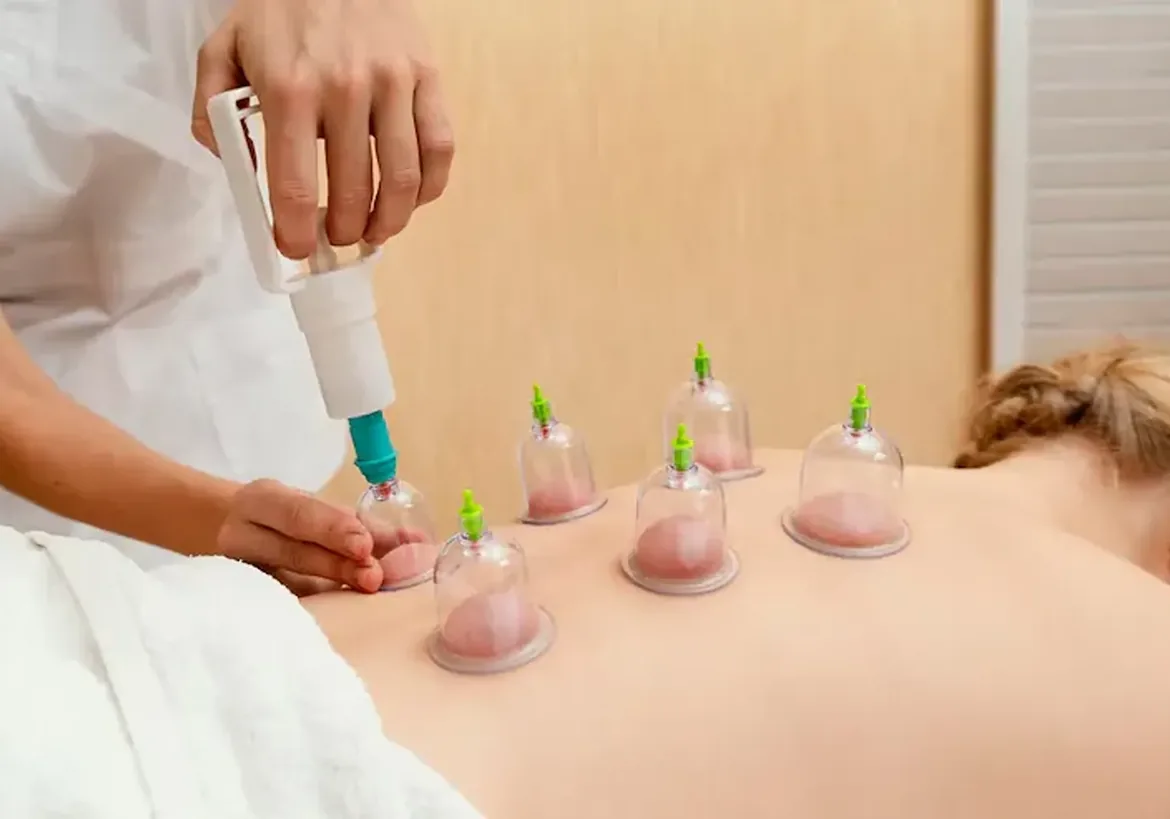Cupping cups applied along a patient's back