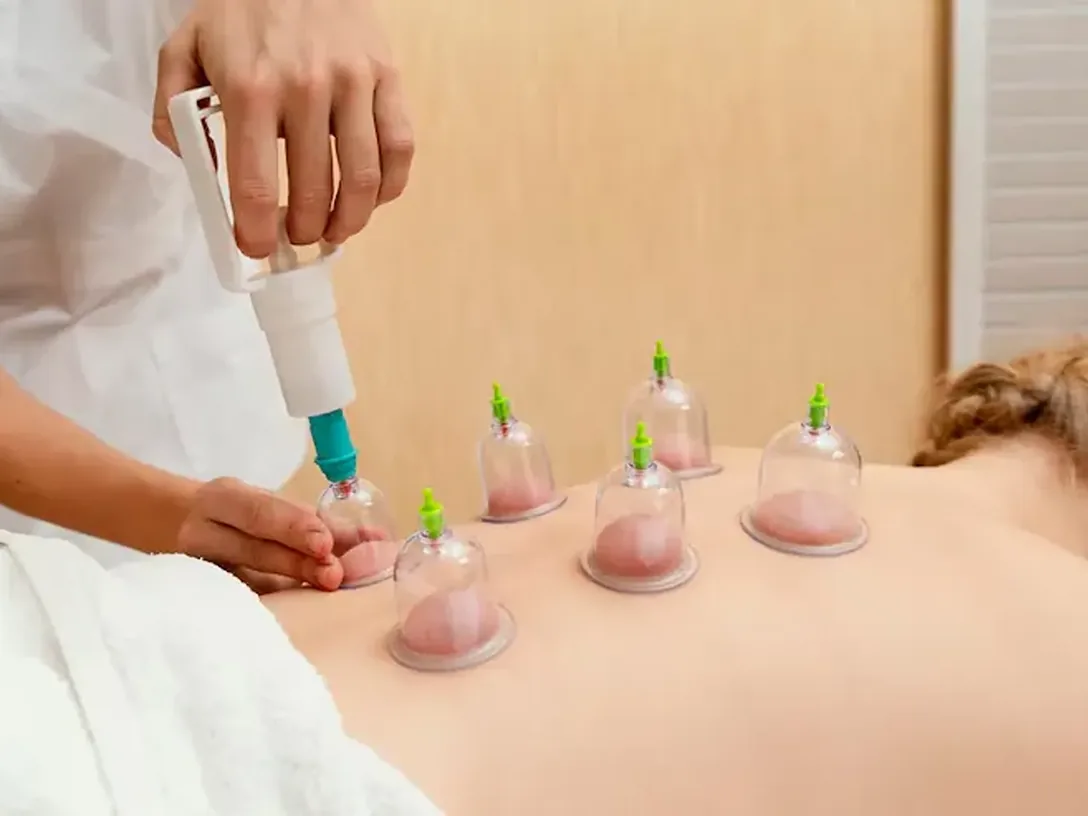 Cupping cups applied along a patient's back